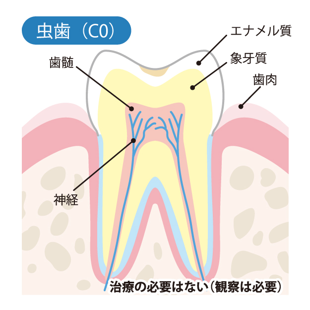 戸塚区（舞岡）の歯医者、まいおか町歯科で、むし歯治療