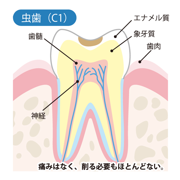 戸塚区（舞岡）の歯医者、まいおか町歯科で、むし歯治療