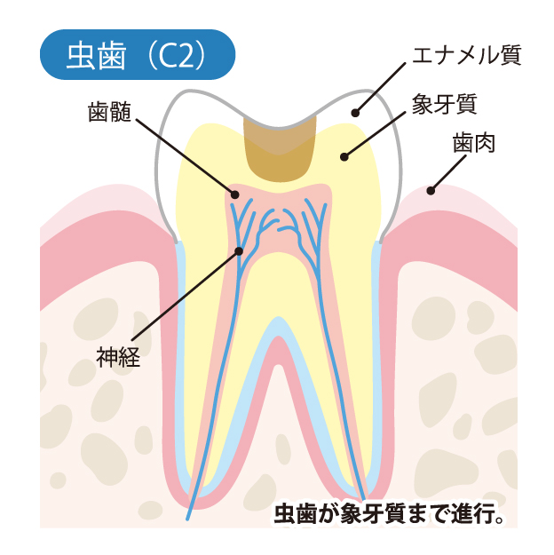 戸塚区（舞岡）の歯医者、まいおか町歯科で、むし歯治療