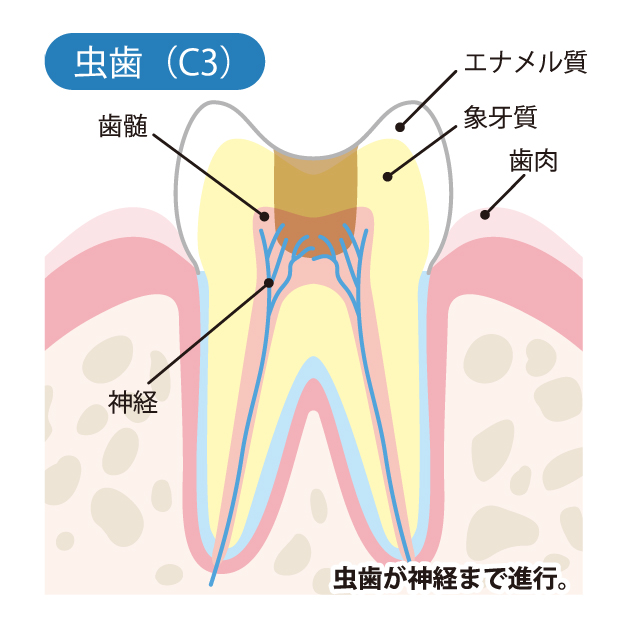 戸塚区（舞岡）の歯医者、まいおか町歯科で、むし歯治療