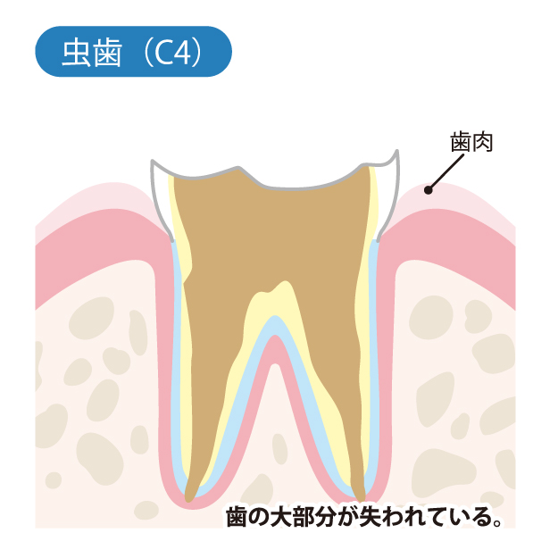 戸塚区（舞岡）の歯医者、まいおか町歯科で、むし歯治療