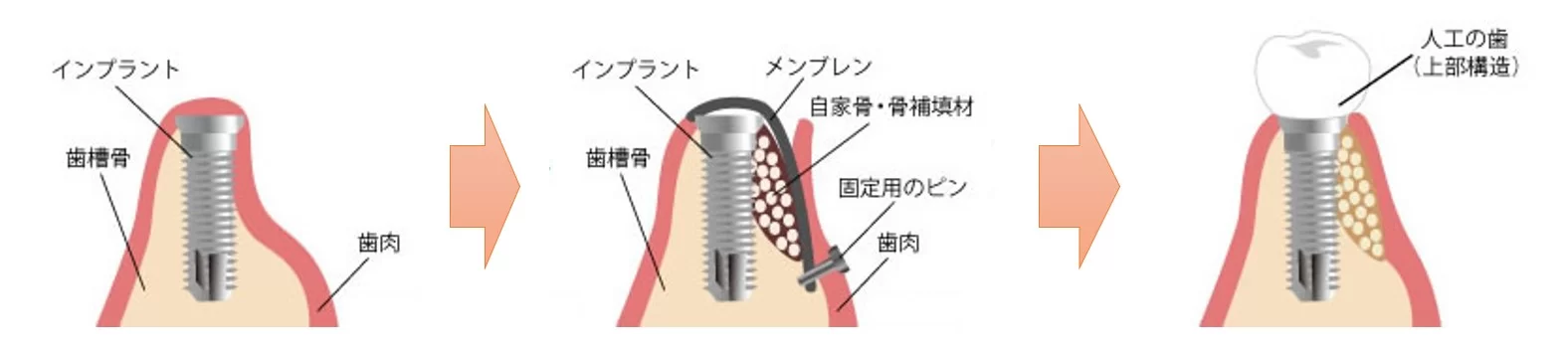 戸塚区（舞岡）の歯医者、まいおか町歯科のGBR法