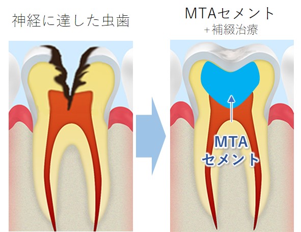 戸塚区（舞岡）の歯医者、まいおか町歯科のMTAセメント