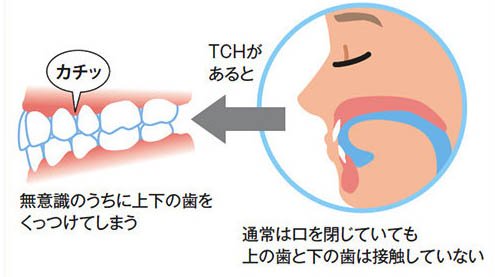 戸塚区（舞岡）の歯医者、まいおか町歯科の顎関節症治療